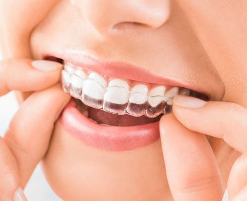 Invisalign First St Louis MO